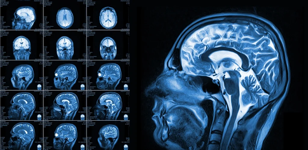The Importance of MRI in Neurology: How Advanced Imaging Helps Diagnose Neurological Conditions